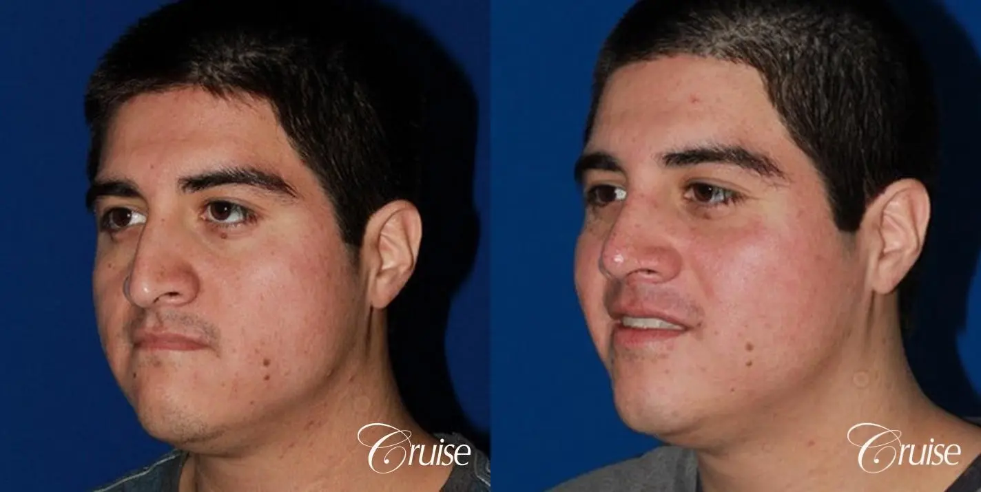 Rhinoplasty: Dorsal Hump & Droopy Tip Correction - Before and After 3