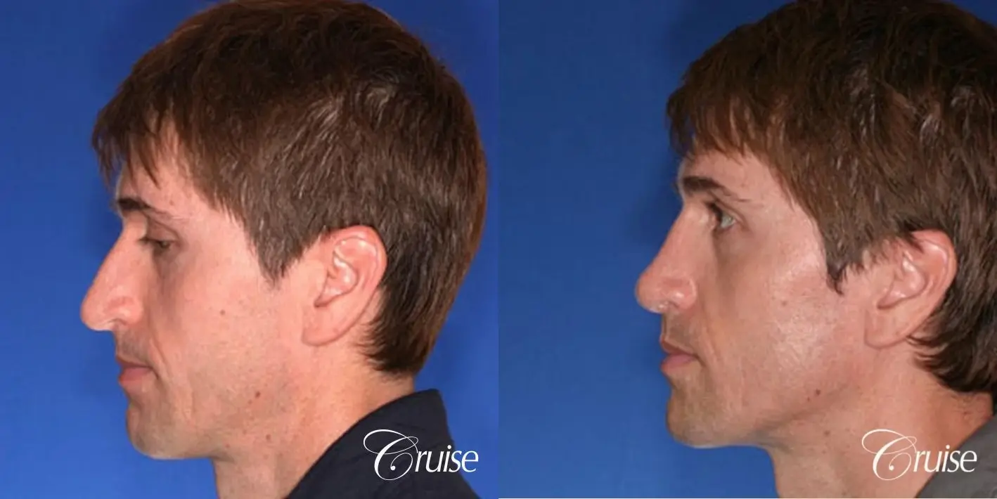Rhinoplasty: Dorsal Hump Correction  - Before and After 2