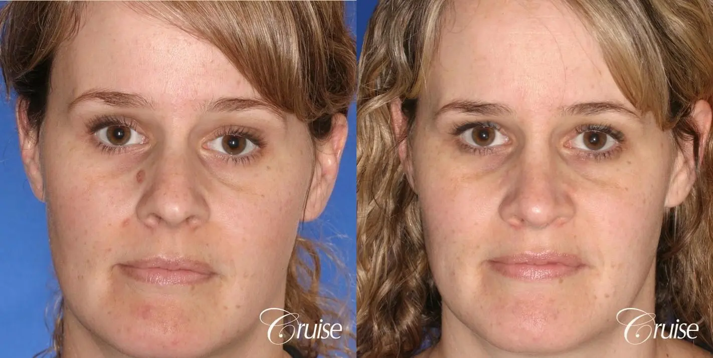 Rhinoplasty: Dorsal Hump Reduction - Before and After 1