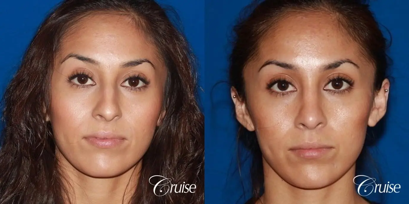 Rhinoplasty: Dorsal Hump Reduction & Droopy Tip Correction  - Before and After 1