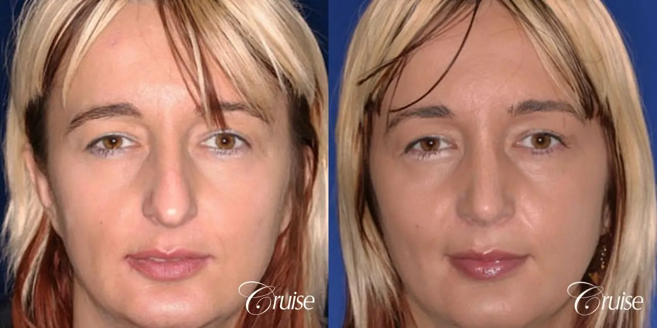 Rhinoplasty - Before and After 1