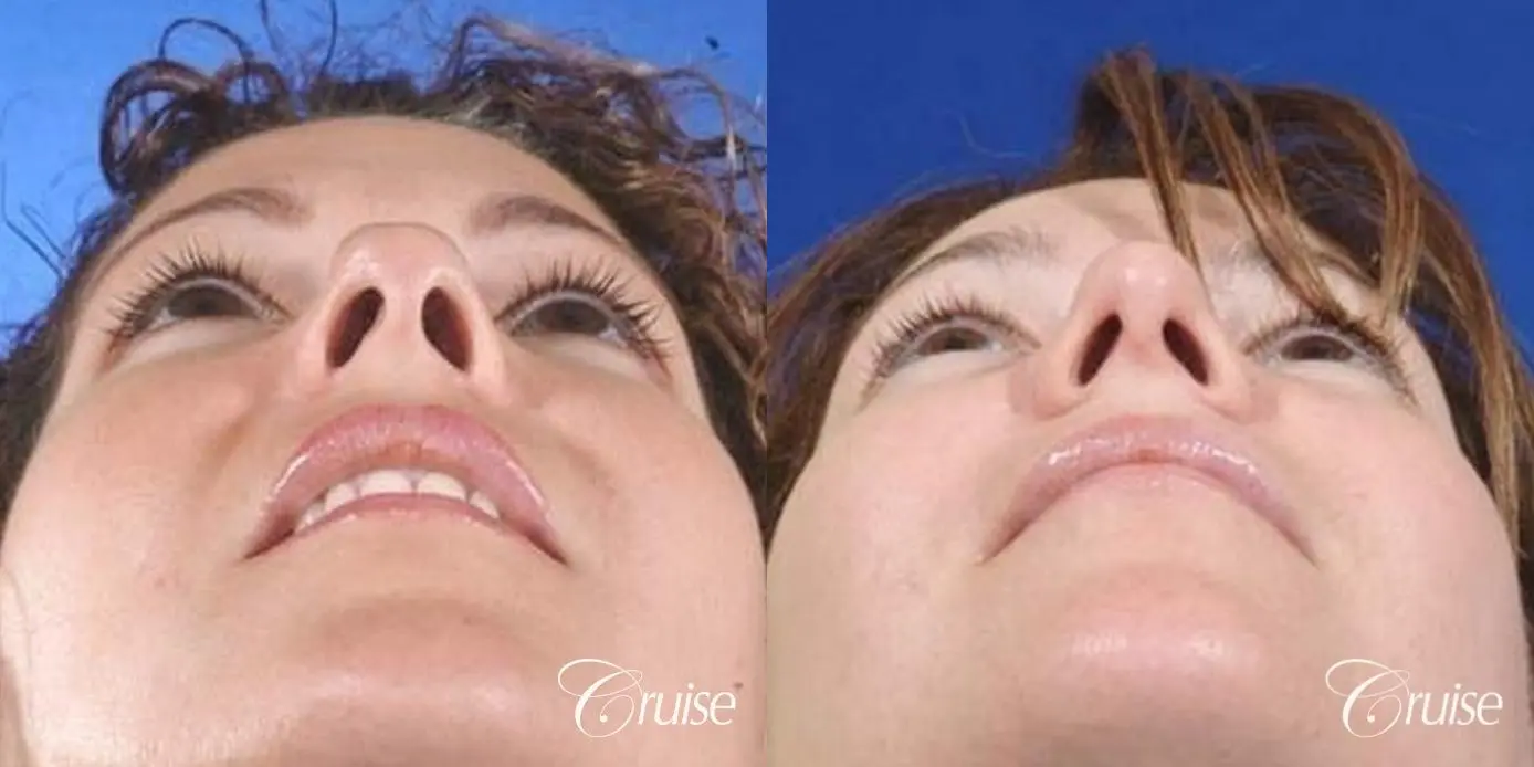 Rhinoplasty: Nose Lengthening & Bulbous Tip Correction - Before and After 3