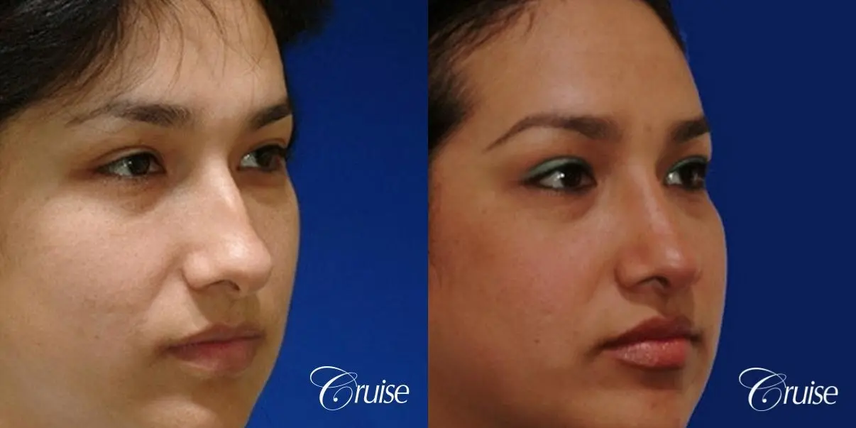 Rhinoplasty: Dorsal Hump Reduction  - Before and After 3
