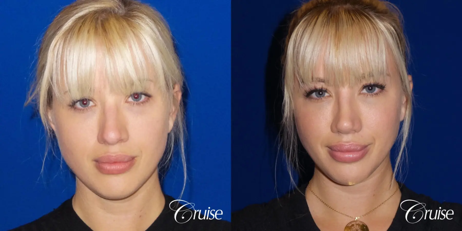 Rhinoplasty: Patient 63 - Before and After 1