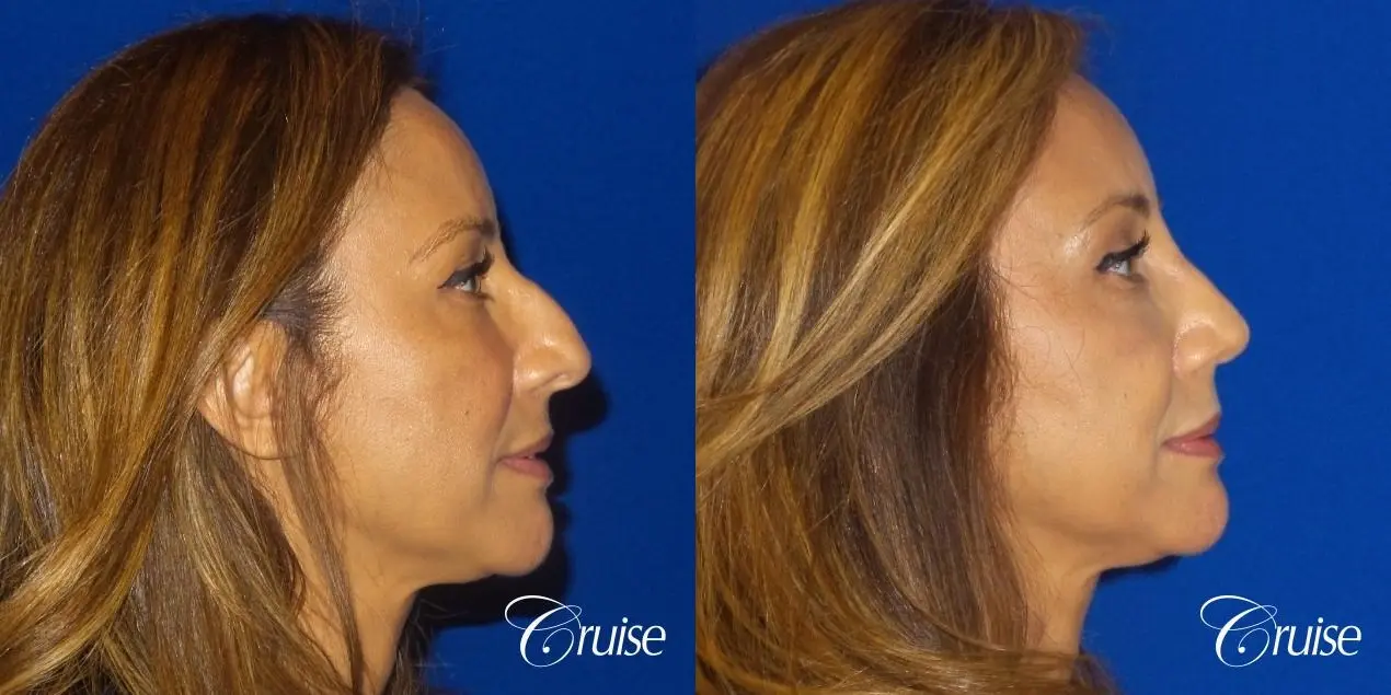 Rhinoplasty: Hump Reduction & Tip Shortening - Before and After 4