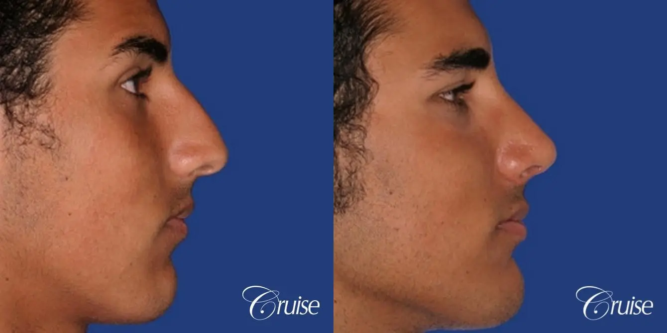 good nose job before and after