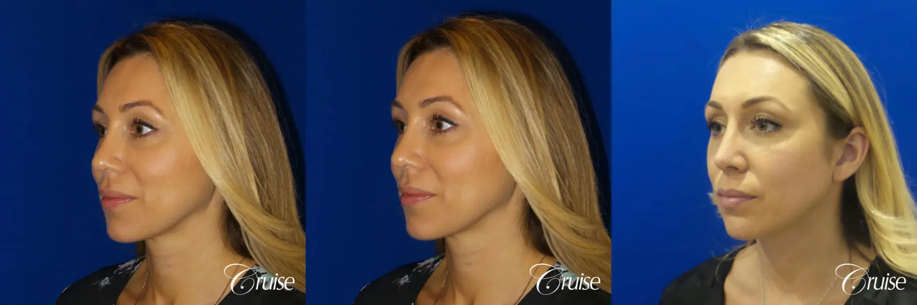 Rhinoplasty: Hump Reduction & Nasal Tip Refinement - Before and After 5