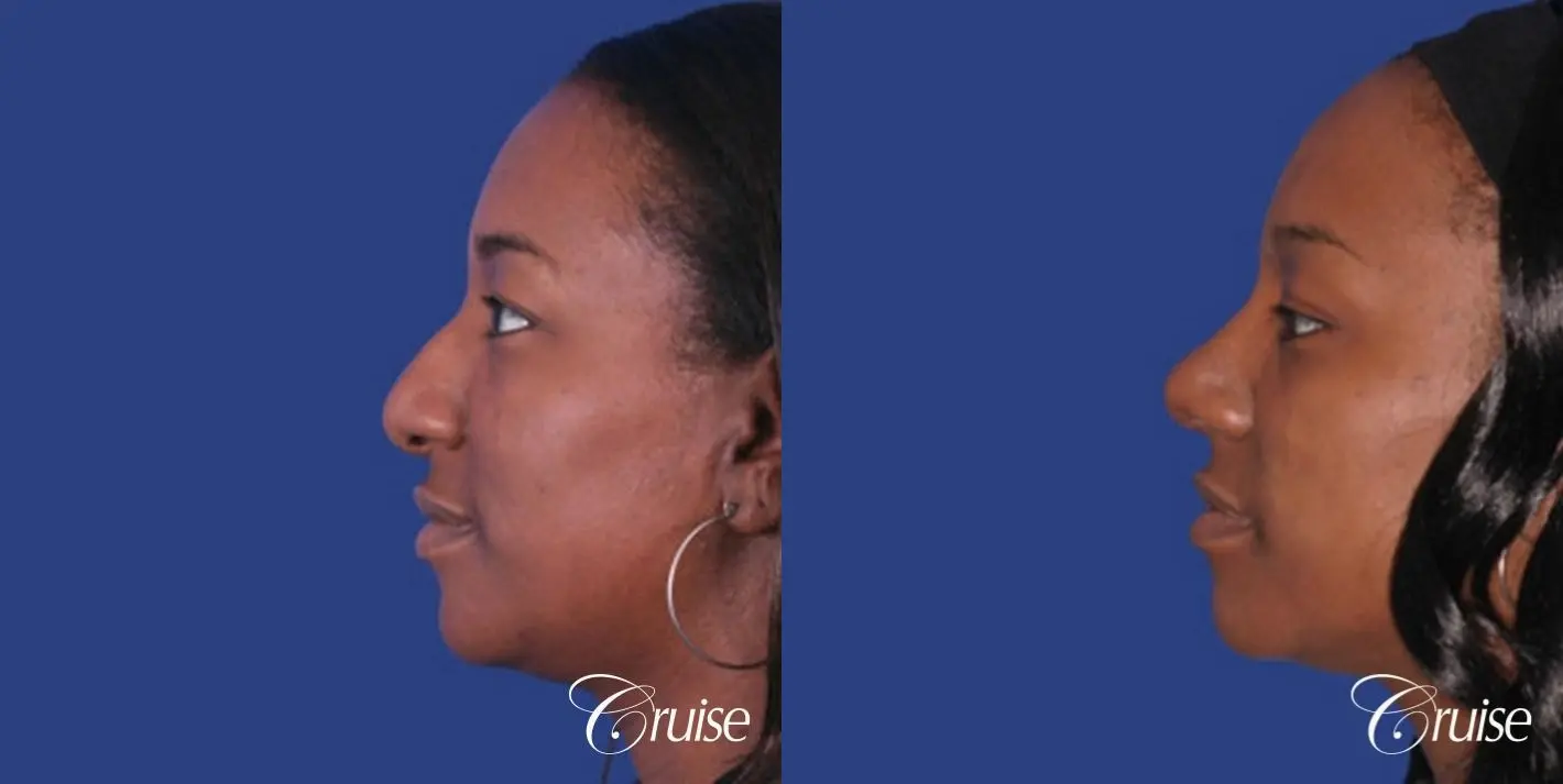 Rhinoplasty: Bridge Narrowing & Tip Elevation  - Before and After 2