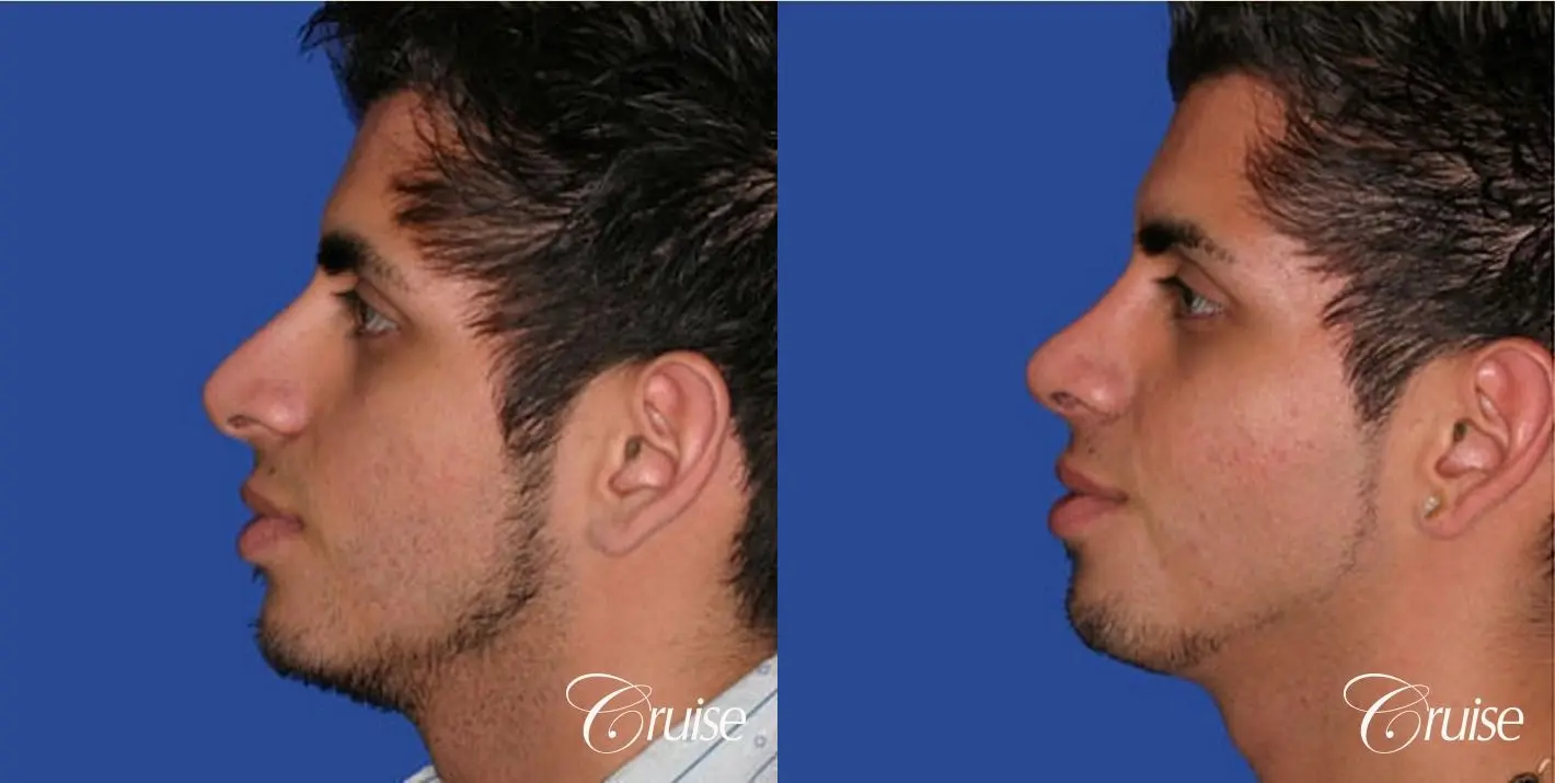 Rhinoplasty: Tip Refinement  - Before and After 2