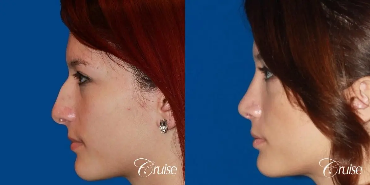 Rhinoplasty: Dorsal Hump Reduction  - Before and After 3