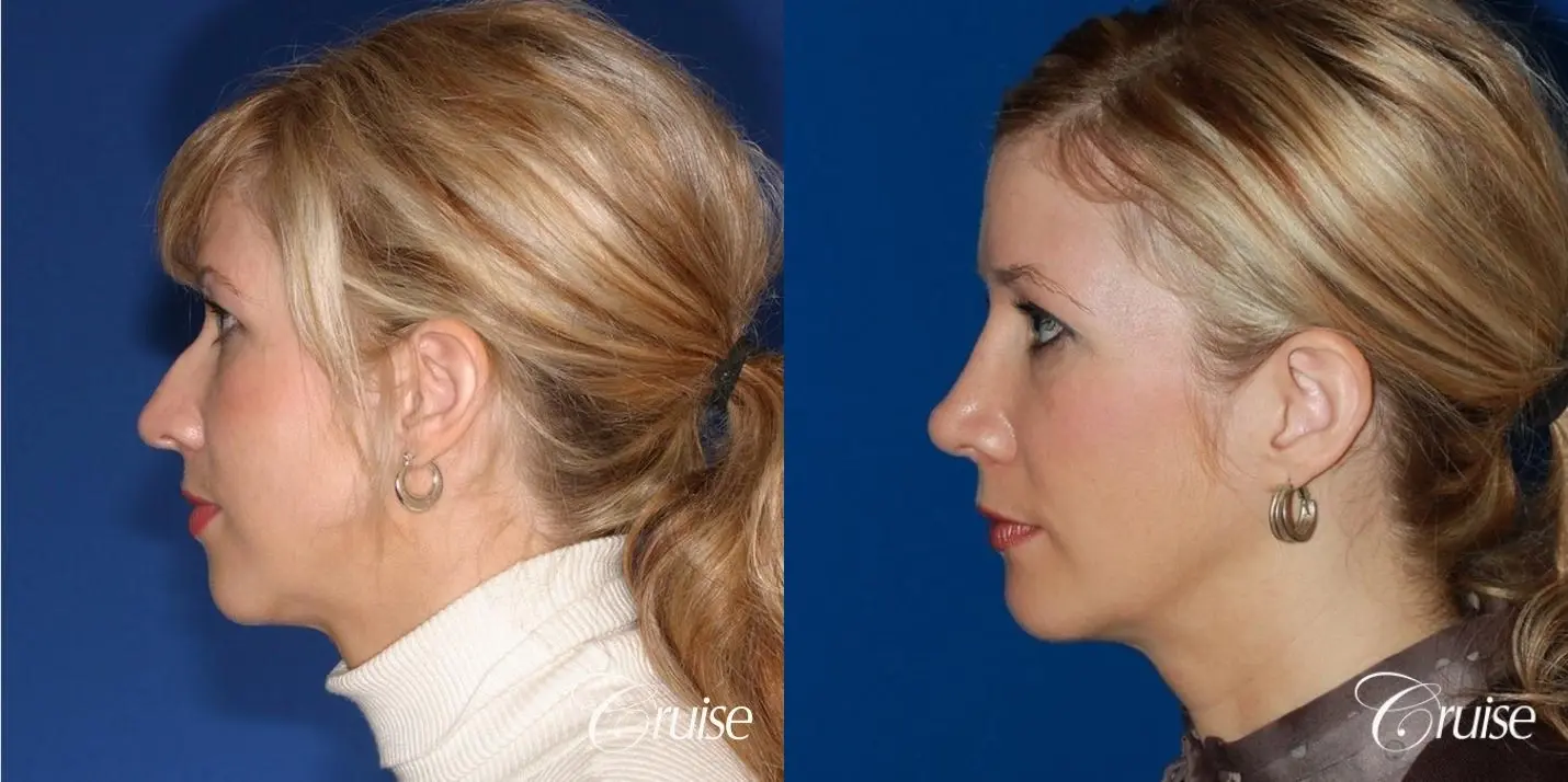 Rhinoplasty w/ Chin Augmentation & Temple Lift - Before and After 3