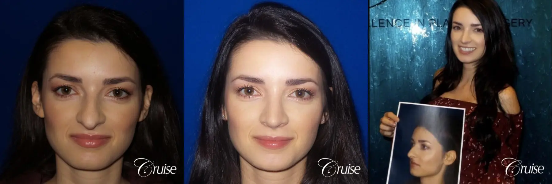 Rhinoplasty specialist Orange County CA - Before and After 1