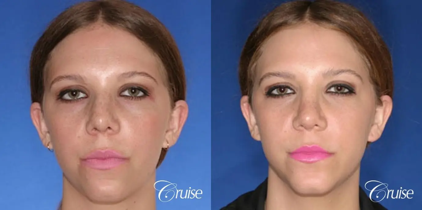 Rhinoplasty Revision w/ Chin Augmentation  - Before and After 1
