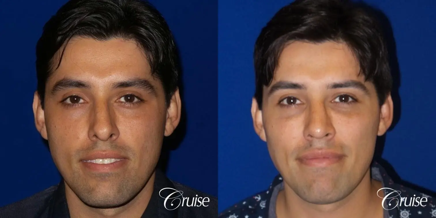 Rhinoplasty: Patient 64 - Before and After 1