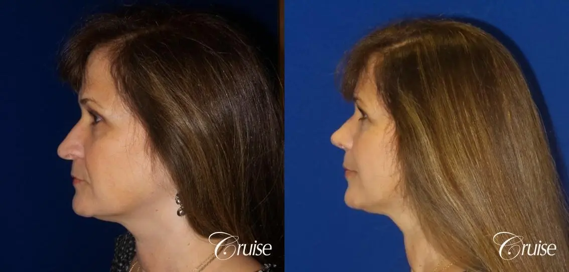 Rhinoplasty: Hump Reduction & Tip Shortening - Before and After 3