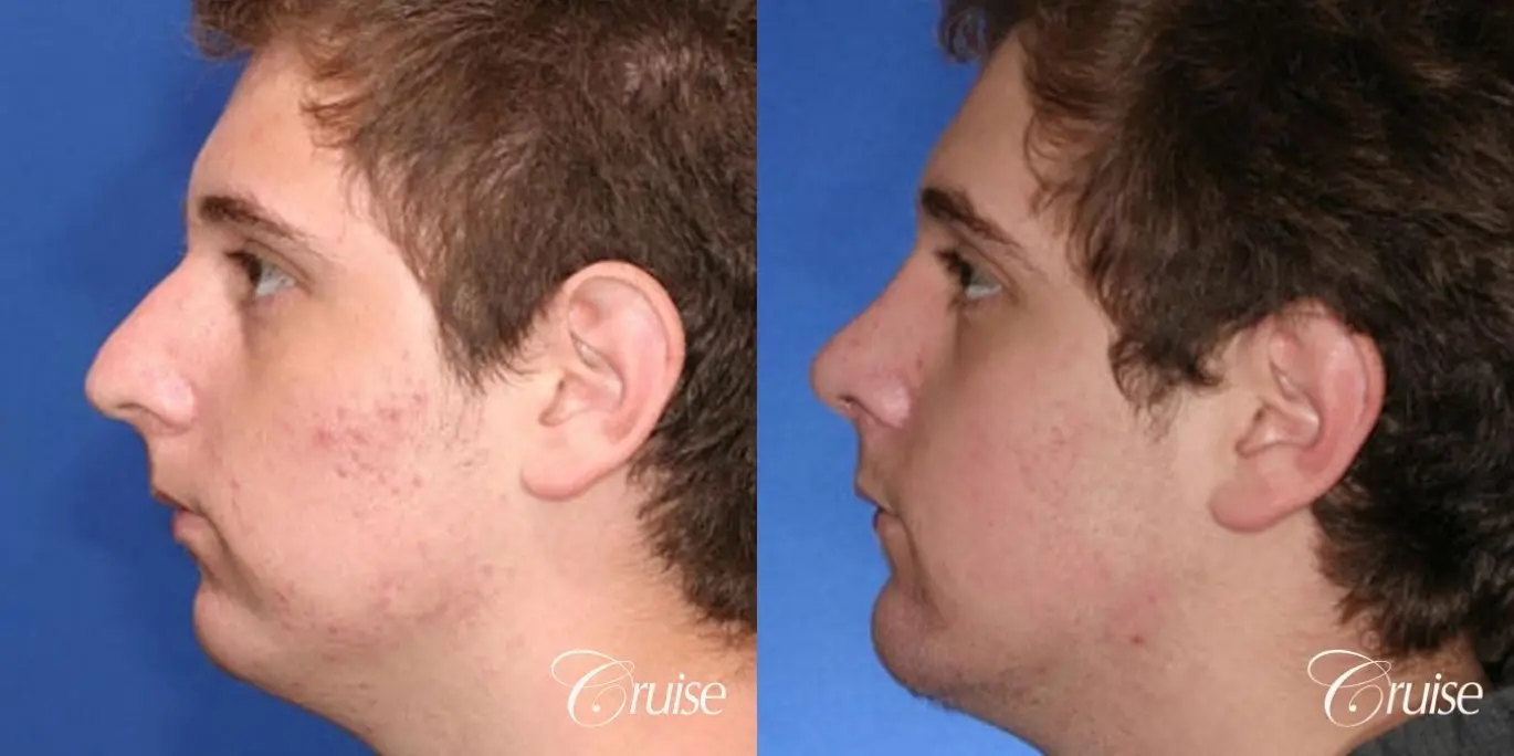 Rhinoplasty: Dorsal Hump Reduction & Deviated Septum Correction  - Before and After 2
