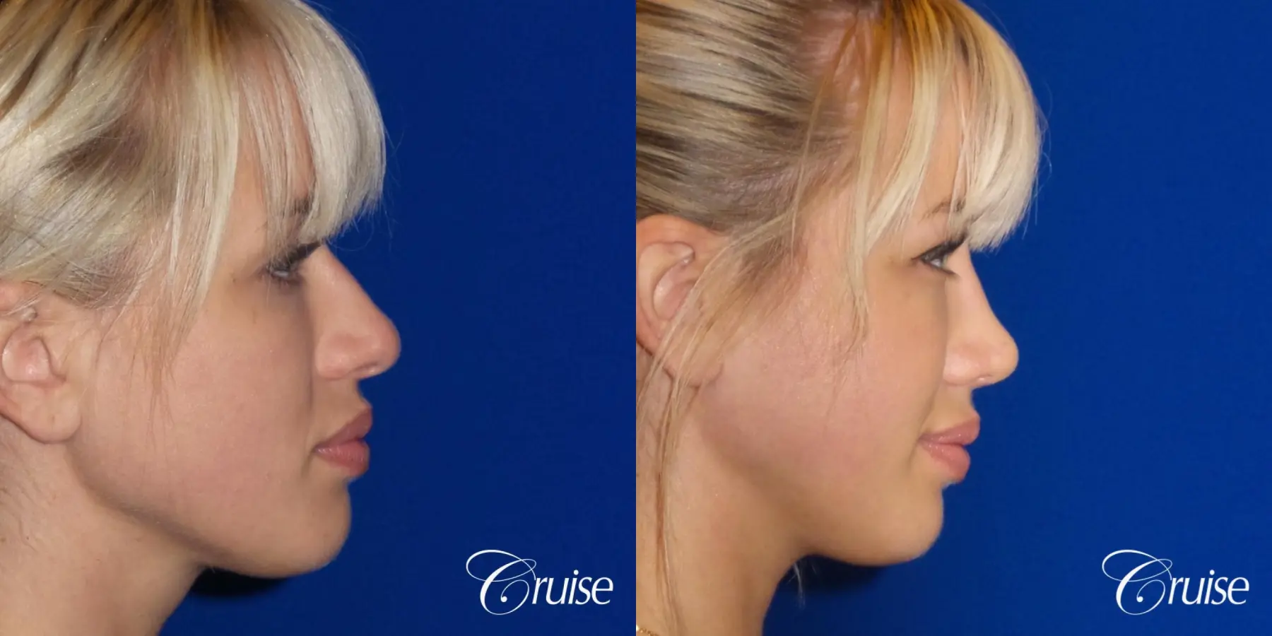 Rhinoplasty: Patient 63 - Before and After 3