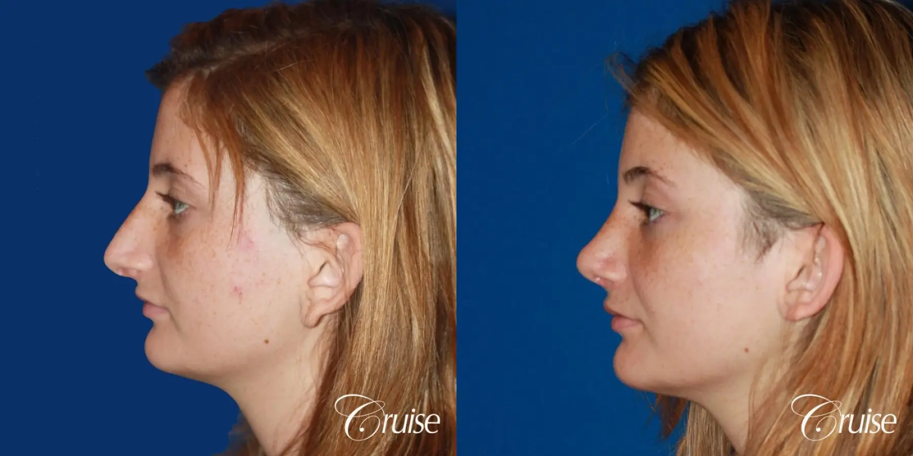 Rhinoplasty: Hump Reduction & Tip Shortening  - Before and After 2
