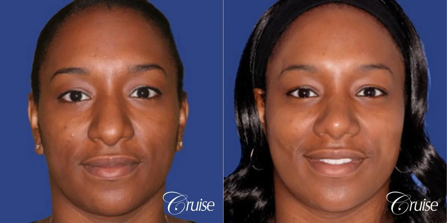 Rhinoplasty: Bridge Narrowing & Tip Elevation  - Before and After 1