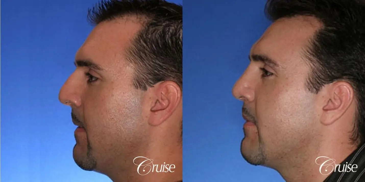 Rhinoplasty: Dorsal Hump Correction  - Before and After 2