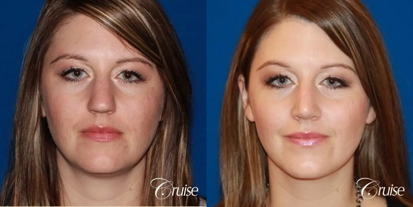 Rhinoplasty: Bridge Narrowing - Before and After  