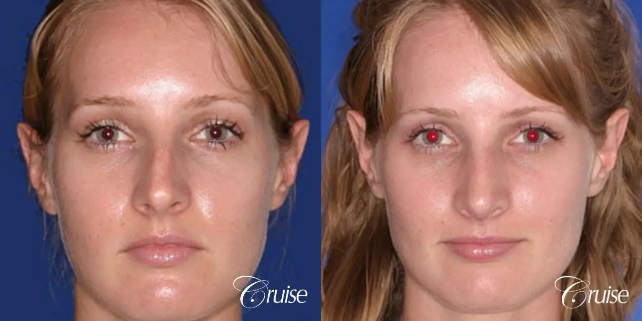 Rhinoplasty: Nose Reduction & Tip Narrowing - Before and After 1