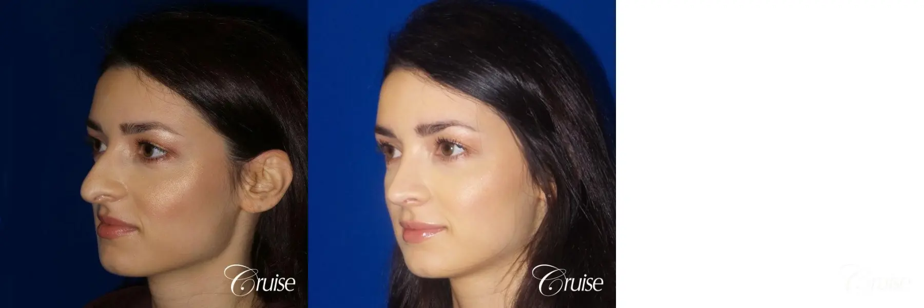 Rhinoplasty specialist Orange County CA - Before and After 2