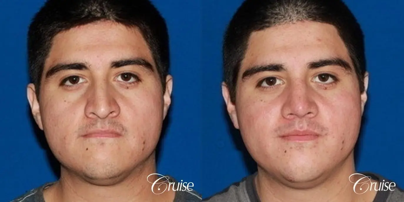 Rhinoplasty: Dorsal Hump & Droopy Tip Correction - Before and After 1