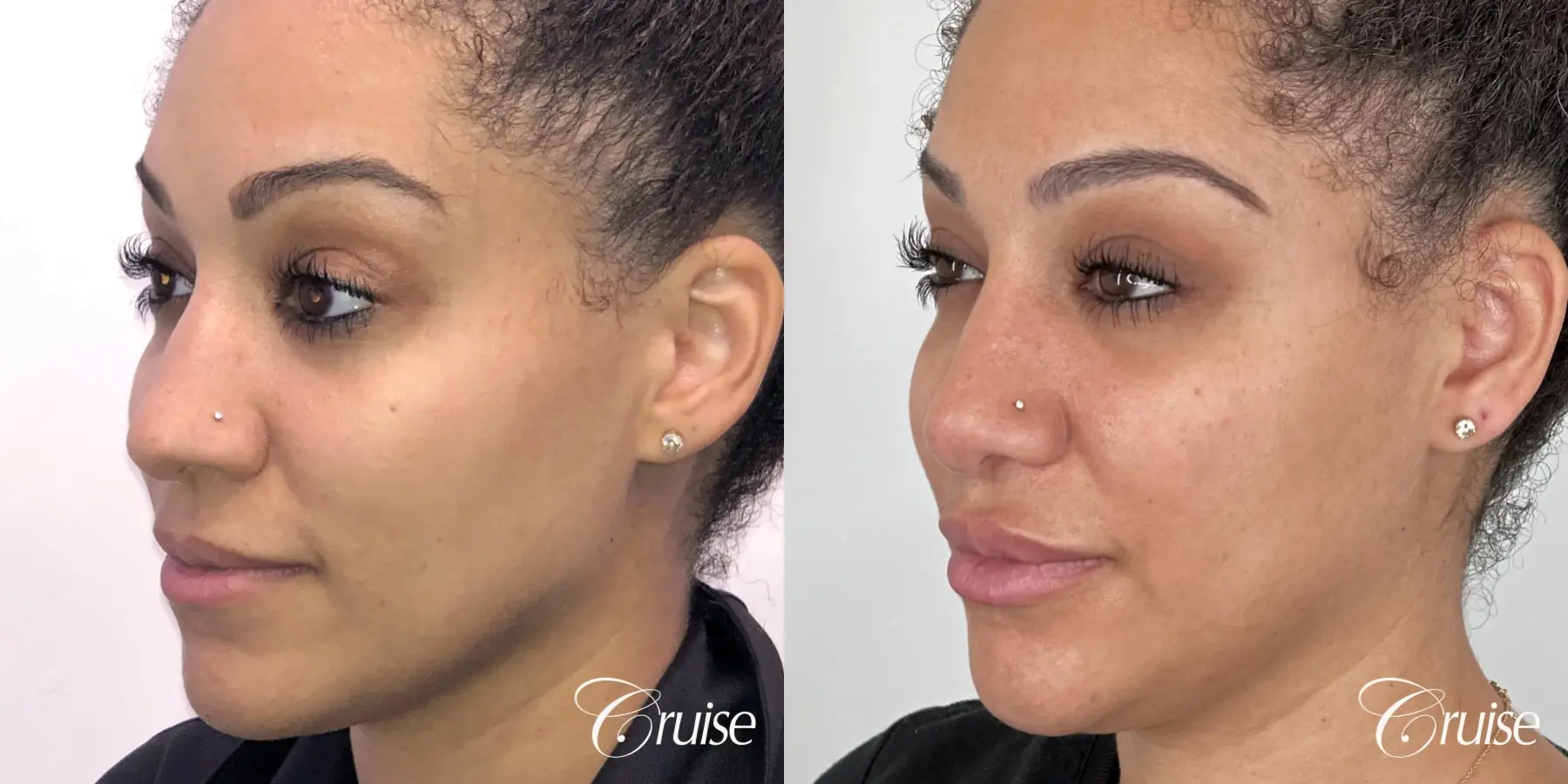 rhinoplasty orange county - Before and After 2