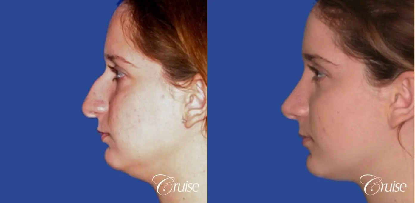 Rhinoplasty: Hanging Columella, Deviated Nose, Bulbous Tip Correction  - Before and After 2