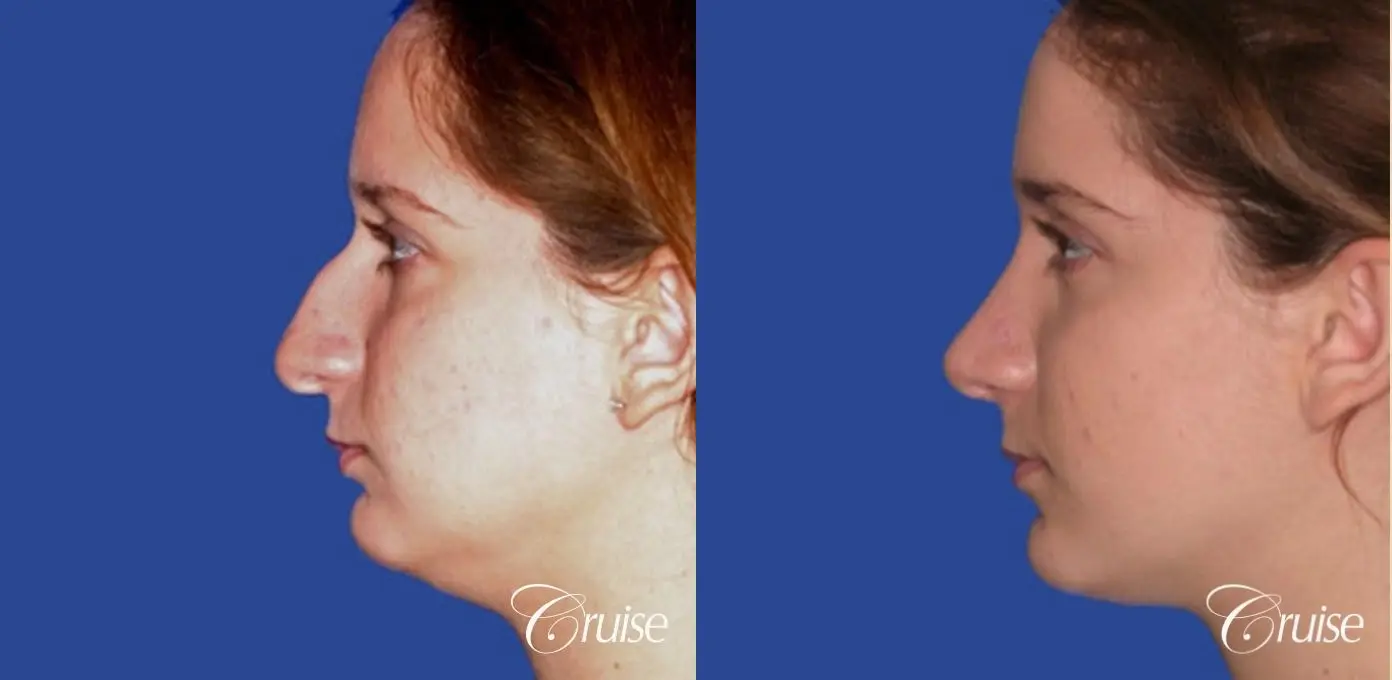 Rhinoplasty: Hanging Columella, Deviated Nose, Bulbous Tip Correction - Before and After 2