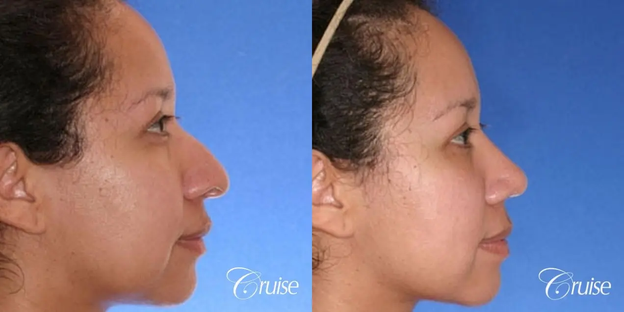 Rhinoplasty: Droopy, Narrow Tip Correction  - Before and After 4