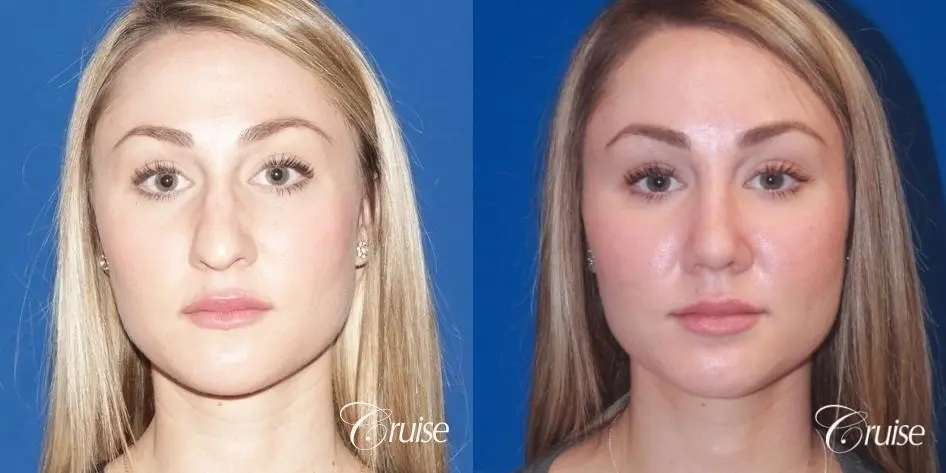 good nose job before and after