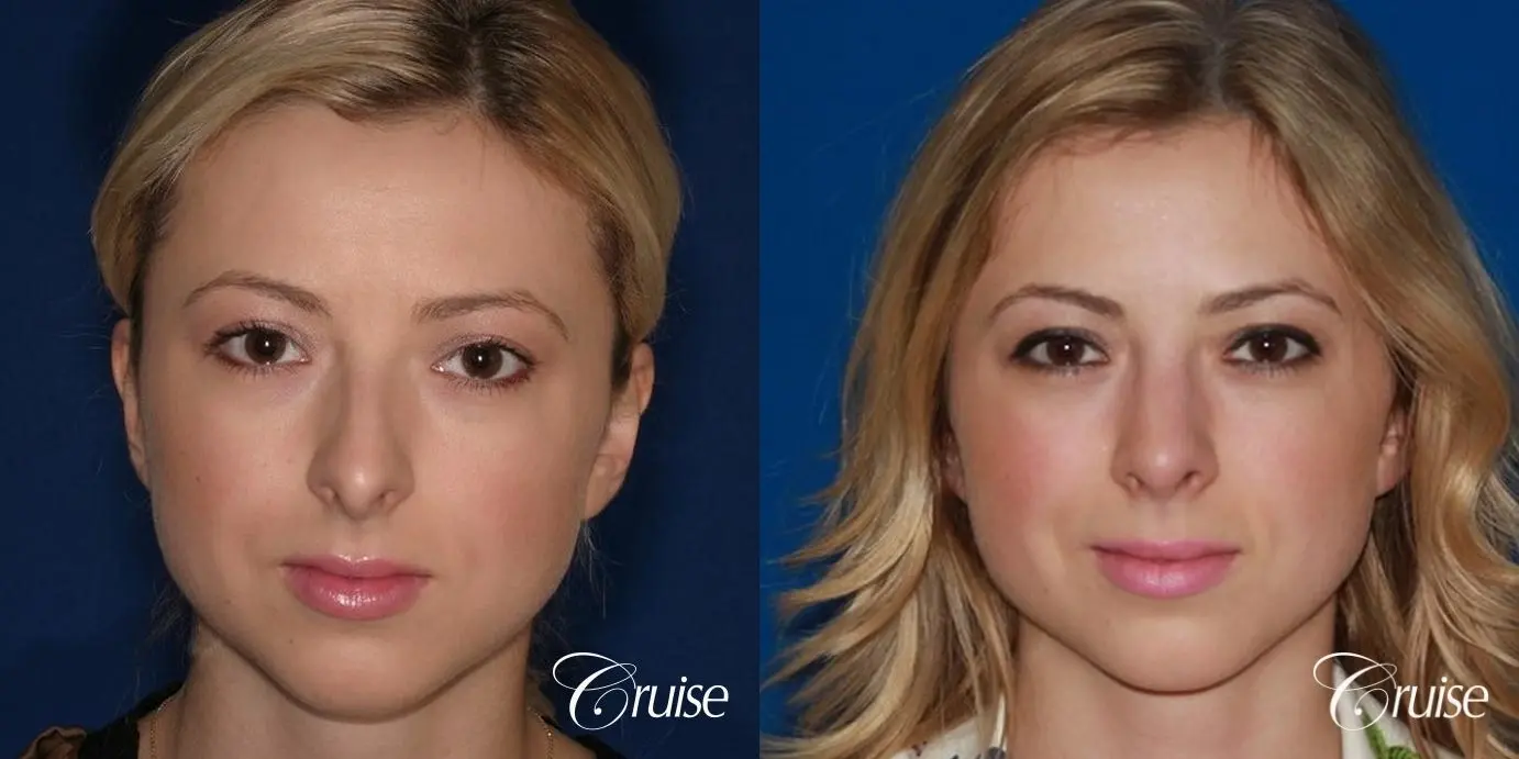 Rhinoplasty: Dorsal Hump Reduction  - Before and After 1