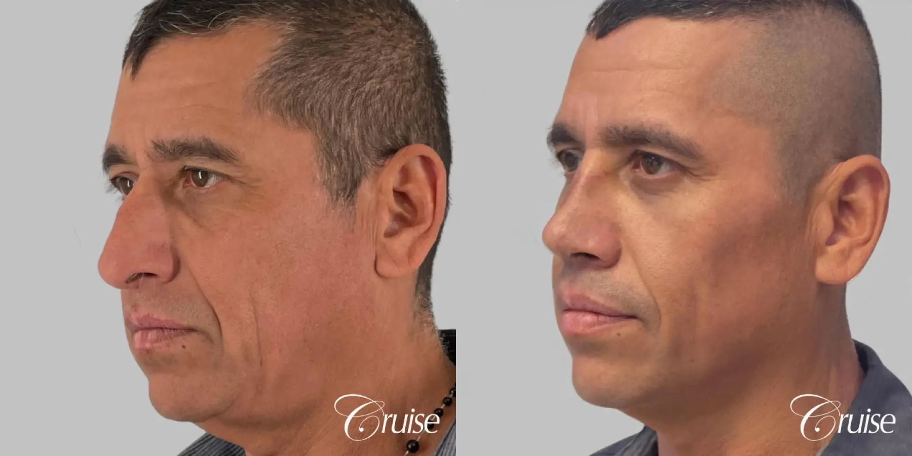 Male - Rhinoplasty, Hump Reduction - Before and After 3