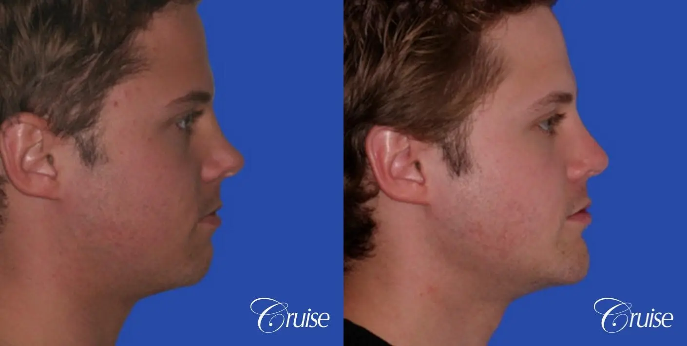 Rhinoplasty w/ Chin Augmentation: Tip Correction  - Before and After 2