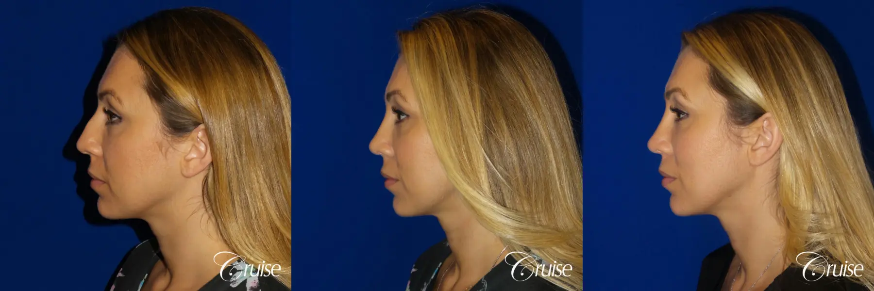 Rhinoplasty: Hump Reduction & Nasal Tip Refinement - Before and After 4
