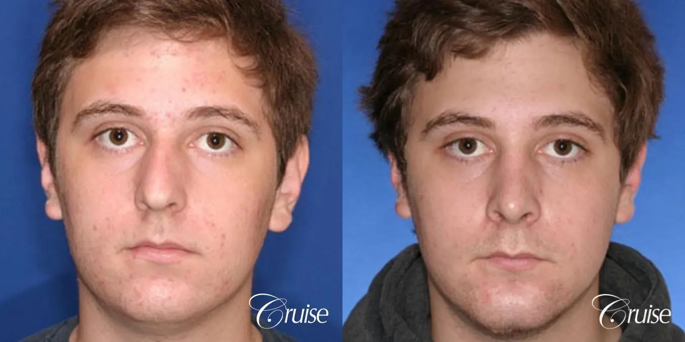 Rhinoplasty: Dorsal Hump Reduction & Deviated Septum Correction  - Before and After 1