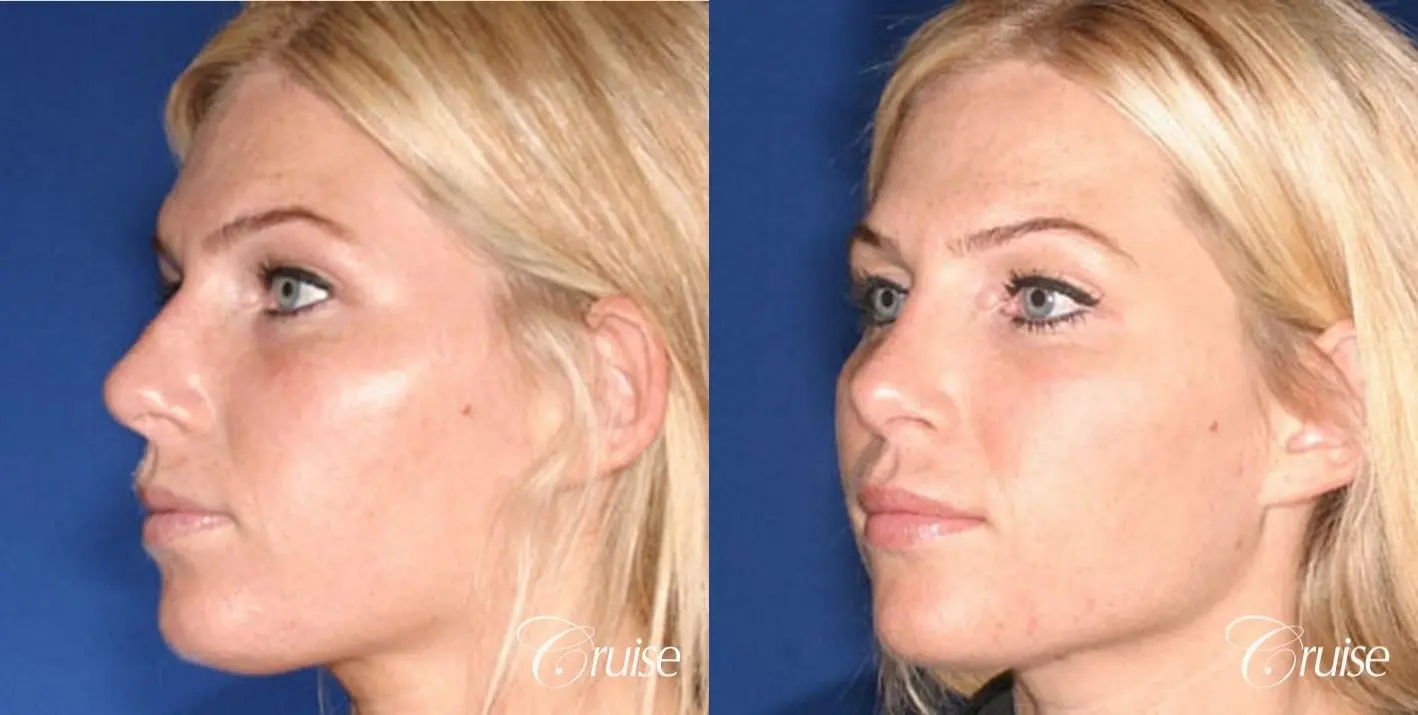 Rhinoplasty Revision: Tip Definition & Rotation  - Before and After 3