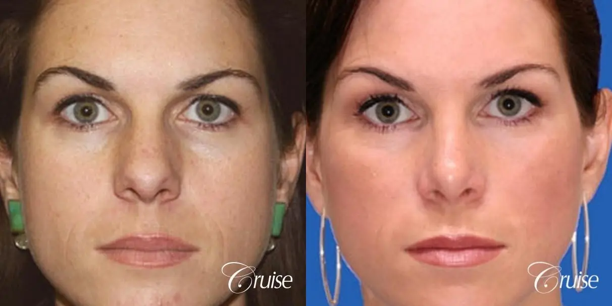 Rhinoplasty: Bulbous Tip Correction  - Before and After 1