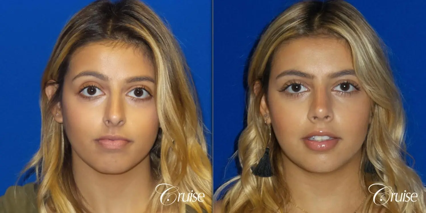 Rhinoplasty: Dorsal Hump & Droopy Tip Correction - Before and After  