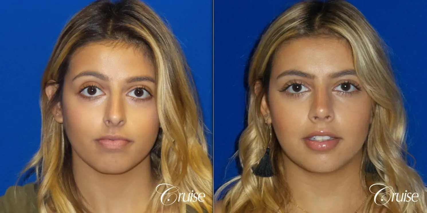 Rhinoplasty: Dorsal Hump & Droopy Tip Correction - Before and After 1