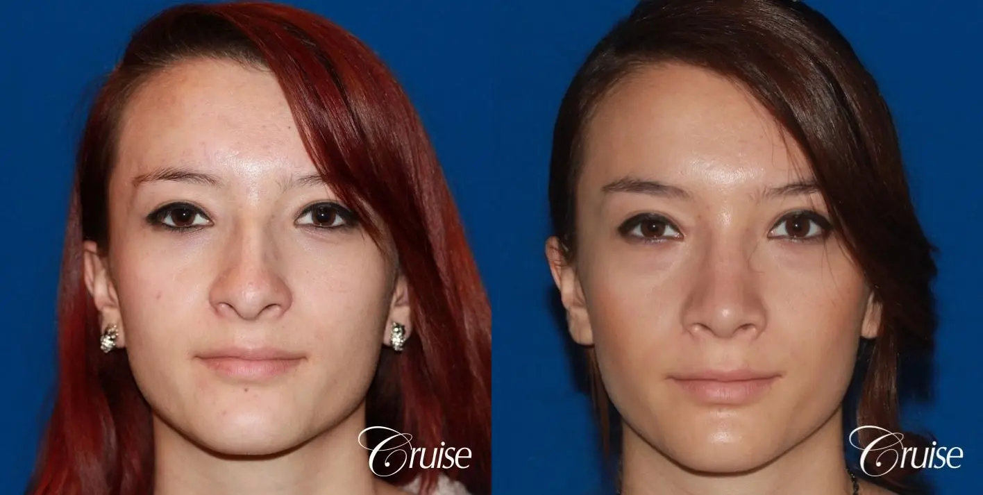 Rhinoplasty: Dorsal Hump Reduction  - Before and After 1