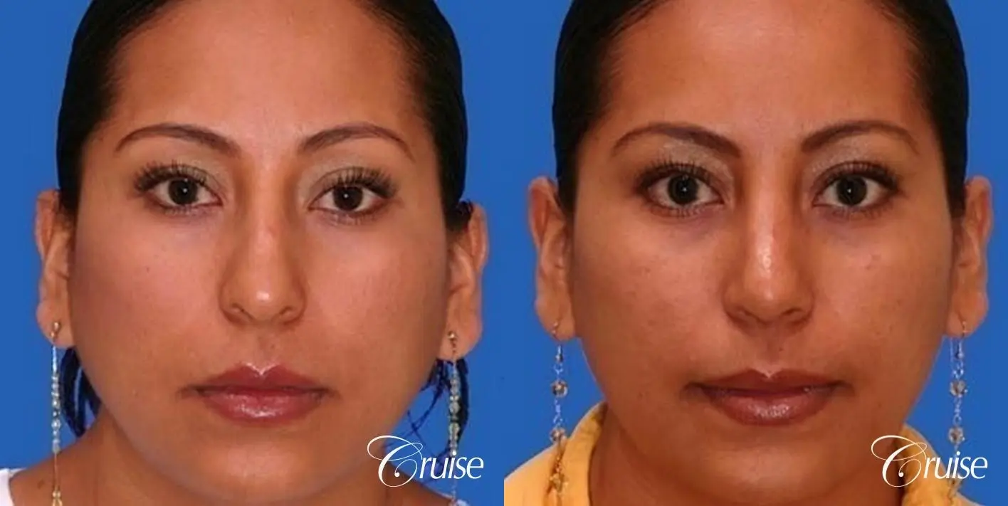 Rhinoplasty: Hump Reduction - Before and After 1