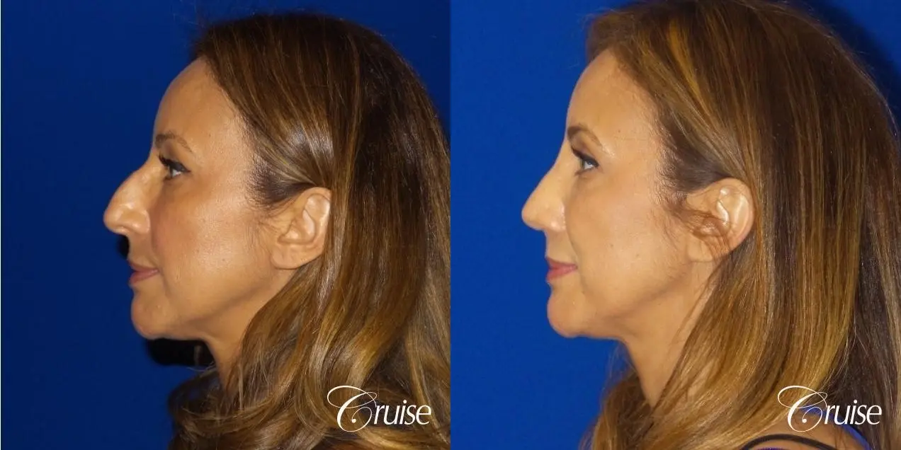 Rhinoplasty: Hump Reduction & Tip Shortening - Before and After 2