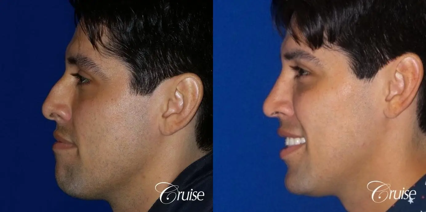 Rhinoplasty: Patient 64 - Before and After 2