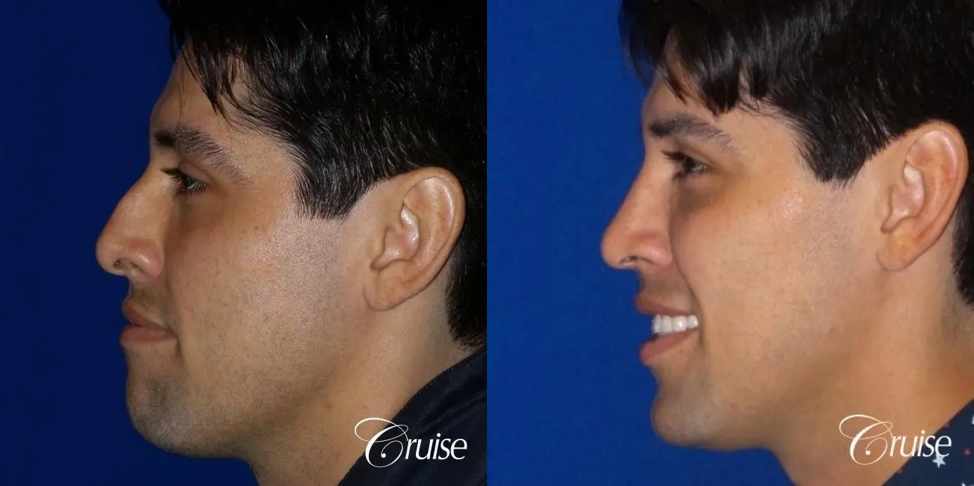 Rhinoplasty: Patient 67 - Before and After 2