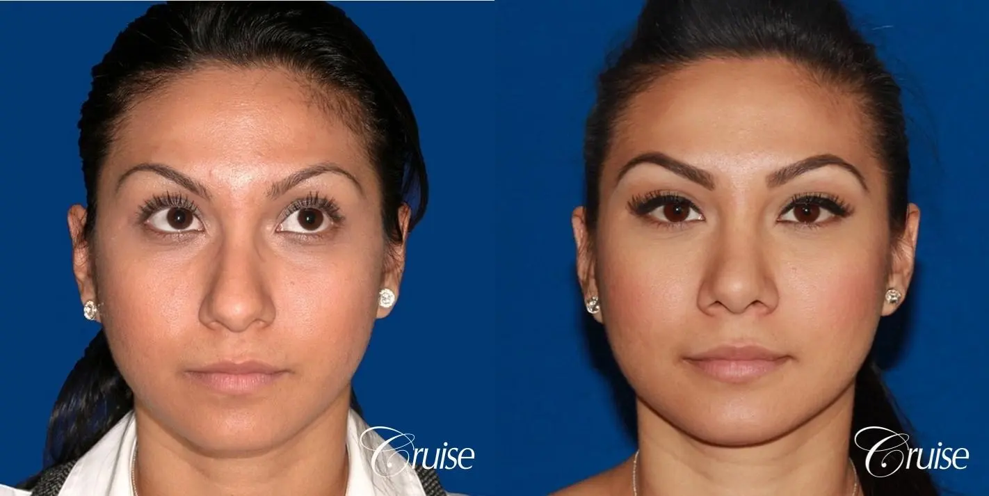 Rhinoplasty: Dorsal Hump Correction  - Before and After 1