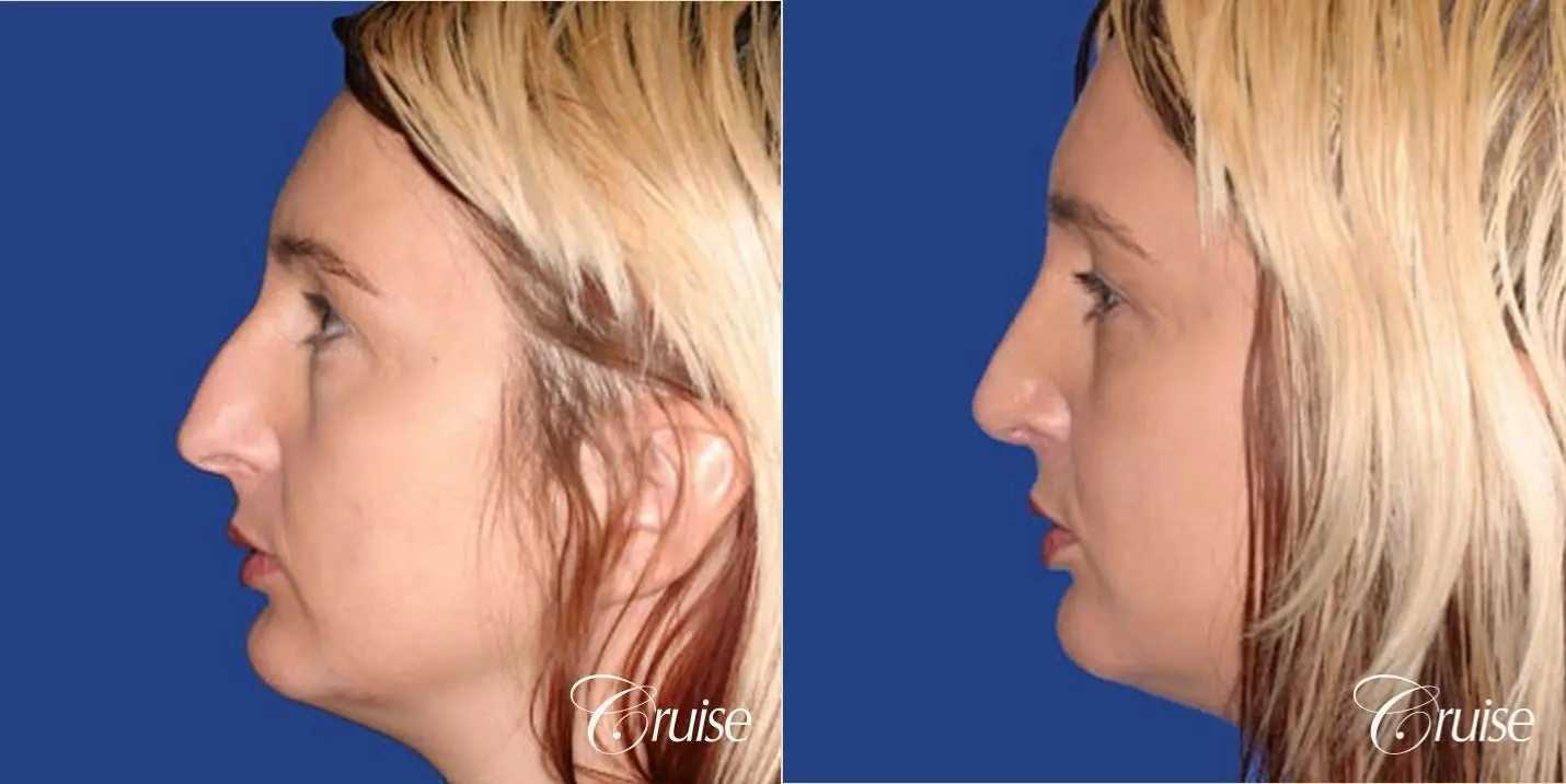 Rhinoplasty - Before and After 2