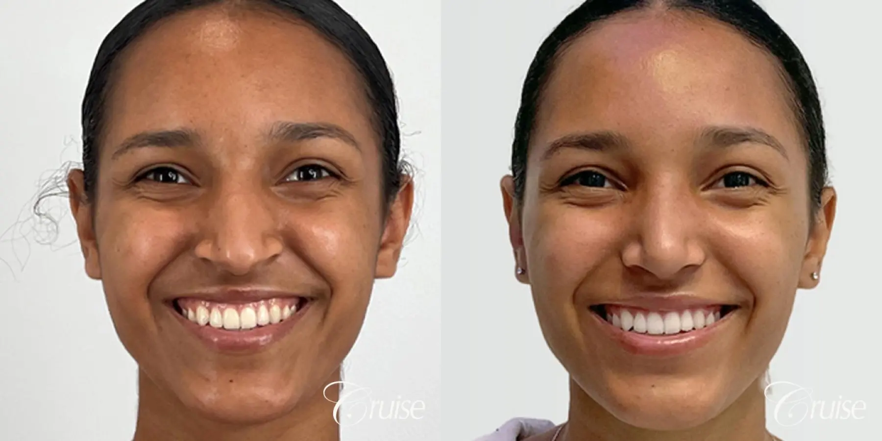 Open Ethnic Rhinoplasty - Before and After 1